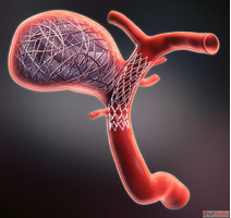 Minimally Invasive Aneurysm Coiling for Brain Treatment IR F...