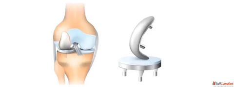 Partial Knee Replacement Surgery in Ahmedabad Advanced Care