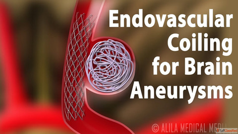 Endovascular Coiling Treatment for Aneurysm Care