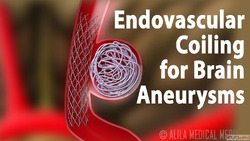 Endovascular Coiling Treatment for Aneurysm Care