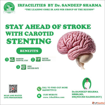 Best Carotid Stent Procedure Done by IR Specialists