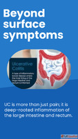 Homeopathy Treatment For Ulcerative Colitis Aura Homeopathy ...