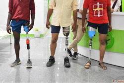 Best 3D Printed Artificial leg Affordable Artificial leg In ...