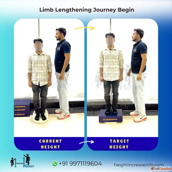Limb Lengthening Surgery in Gurgaon Height Increase Info