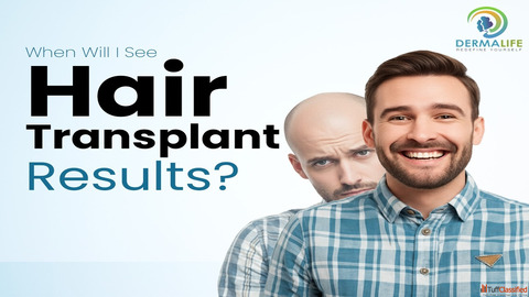 Hair Transplant in Delhi Cost Price List Best Clinic - Complete Guide by Experts