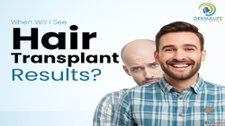 Hair Transplant in Delhi Cost Price List Best Clinic - Compl...