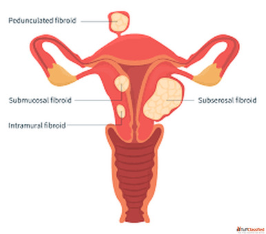 Effective Fibroid Prevention with Advanced Uterine Care IRFacilities