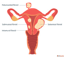 Effective Fibroid Prevention with Advanced Uterine Care IRFa...