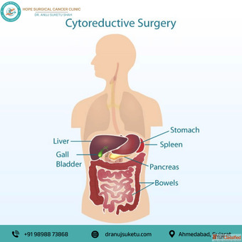 Trusted Cytoreductive Surgery in Ahmedabad for Abdominal Cancer Care