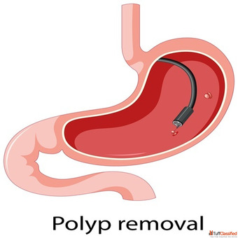 Endoscopy Test for Digestive Problems Gastroenterologist Near Me