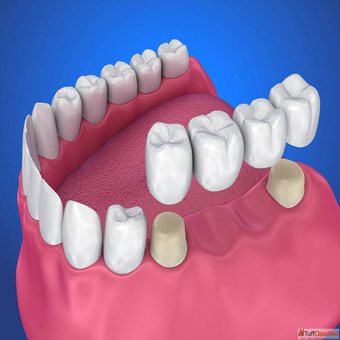 Best Tooth Crown Dental Bridges Treatment in Thoothukudi