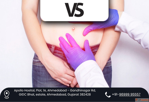 Dr. Vishal Soni - Leading Choice for Complex Hernia Treatment