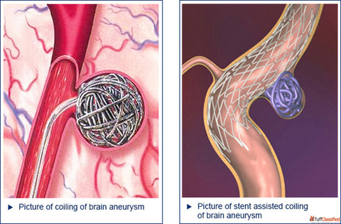 Brain Coiling Treatment for Aneurysm Care