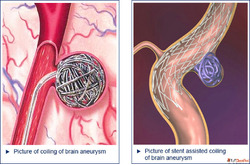 Brain Coiling Treatment for Aneurysm Care