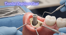 What Really Decides Dental Implant Cost in Mumbai