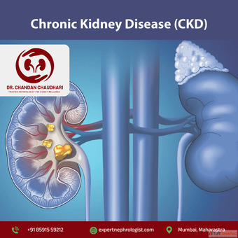 Comprehensive Chronic Kidney Disease Treatment in Mumbai by Expert Nephrologist