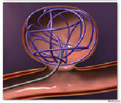 Coiling Surgery for Advanced Brain Aneurysm Treatment