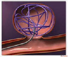 Coiling Surgery for Advanced Brain Aneurysm Treatment