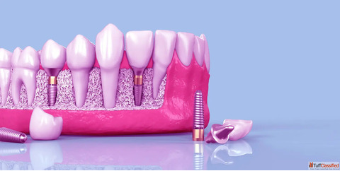 Dental Implants in Dwarka Best Dental Implants in Dwarka