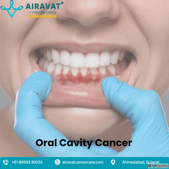Personalized Oral Cavity Cancer Treatment in Ahmedabad Airavat Cancer Care