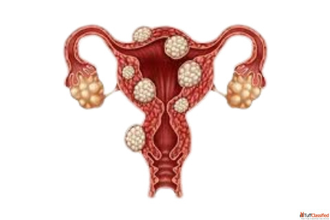Fibroid Prevention - Protect Your Women's Health Naturally