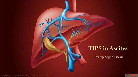 Safe Effective Treatment for Managing Ascites and Variceal