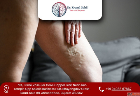 Modern Care for Painful and Swollen Veins