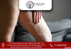 Modern Care for Painful and Swollen Veins