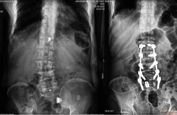 Advanced Spine Surgery in Ahmedabad for Back Neck Pain Treat...