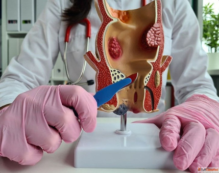 Advanced Care for Fistula and Fissure Problems in Delhi