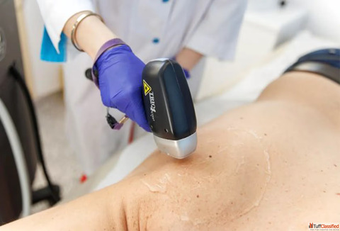 Best Laser Removal Clinic in Gurgaon