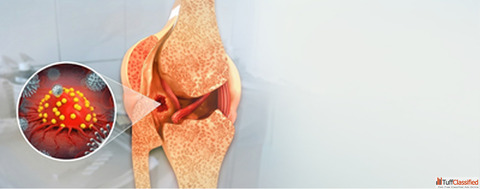 Bone Cancer Hospital in Delhi