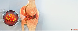 Bone Cancer Hospital in Delhi