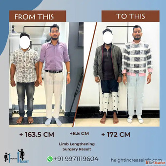 Cosmetic Limb Lengthening Surgery in Gurgaon - Height Increase Info