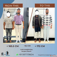 Cosmetic Limb Lengthening Surgery in Gurgaon - Height Increa...