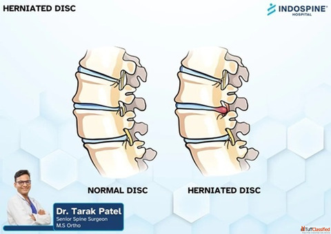 Slipped Disc Treatment in Ahmedabad Advanced Spine Care at IndoSpine