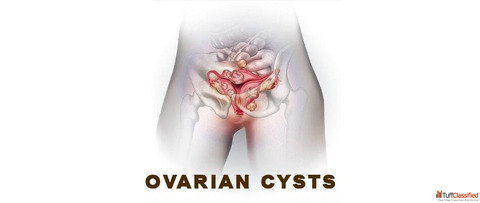 ayurvedic treatment for ovarian cyst in Delhi