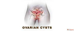 ayurvedic treatment for ovarian cyst in Delhi