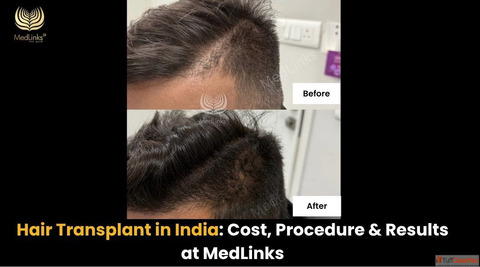 Natural Hair Restoration at MedLinks Hair Transplant
