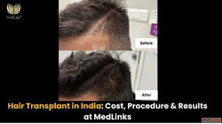 Natural Hair Restoration at MedLinks Hair Transplant