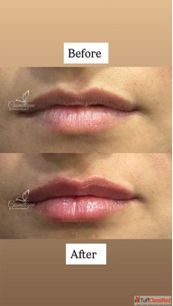 Lip Filler Treatment - Cosmetique by Simrat Sandhu