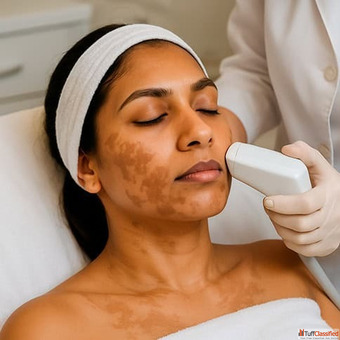 Skin Pigmentation Treatment in Kingston Ontario