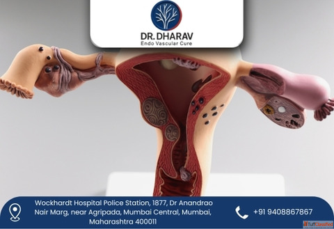 Uterine Fibroid Embolization by Dr. Dharav Kheradia