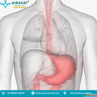 Stomach Cancer Treatment in Ahmedabad - Airavat Cancer Care