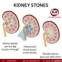 Kidney Stone Treatment in Mumbai by an Expert Kidney Special...