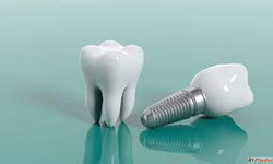 Dental Implants in Dombivli