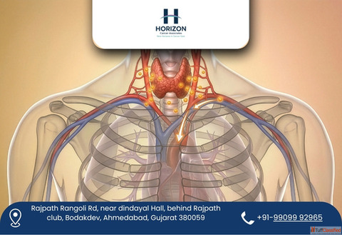 Renowned Thyroid Cancer Surgeon in Ahmedabad