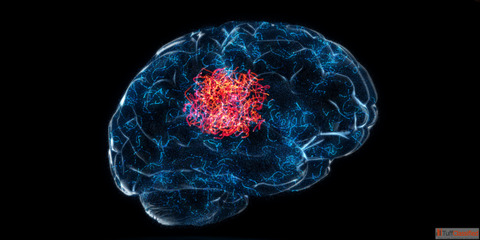 Safe Advanced Solutions for Brain Tumor Treatment in Mumbai