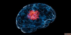 Safe Advanced Solutions for Brain Tumor Treatment in Mumbai