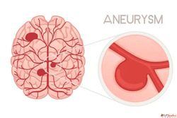 Advanced Endovascular Coiling for Brain Aneurysm Care